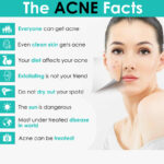 Baby Bright Clear & Treat Acne Cleansing Foam 120g - Image 2